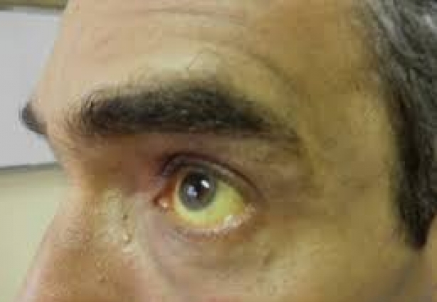 Um dos sintomas da doença é o branco dos olhos ficar amarelado