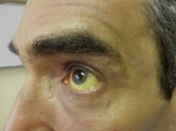 Um dos sintomas da doen&ccedil;a &eacute; o branco dos olhos ficar amarelado