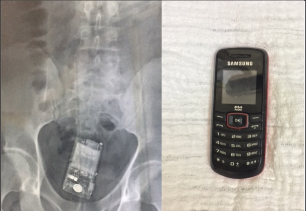 O exame de Raio X (à esquerda) revelou o aparelho celular (à direita) posteriormente retirado do corpo do detento