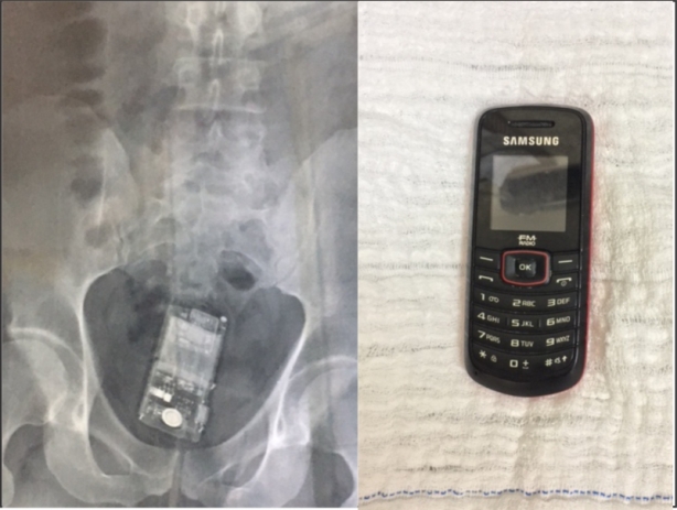 O exame de Raio X (&agrave; esquerda) revelou o aparelho celular (&agrave; direita) posteriormente retirado do corpo do detento